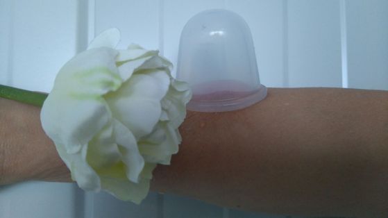 Cuppingmassage